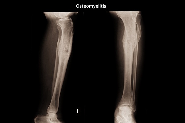 Diagnosis Osteomyelitis Alomedika