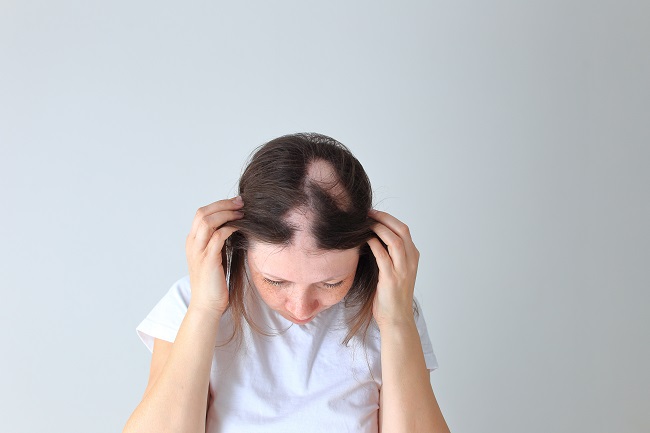 Alopecia penyakit apa