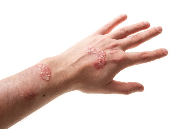 Patofisiologi Neurodermatitis - Alomedika