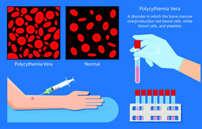 alodokter-polisitemia-vera