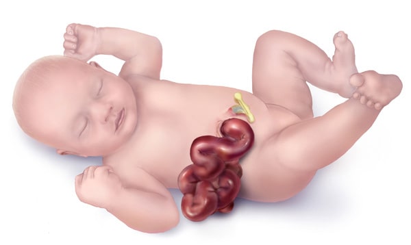 Gastroschisis Patofisiologi Diagnosis Penatalaksanaan Alomedika