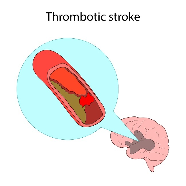 Trombosis Arteri - alodokter