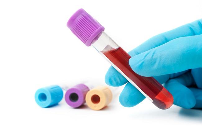Penyebab Darah Kental Dan Cara Mencegahnya Alodokter 5252