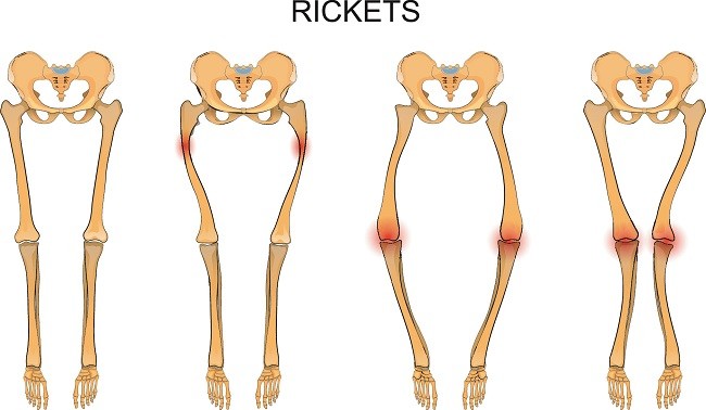 rakitis-alodokter