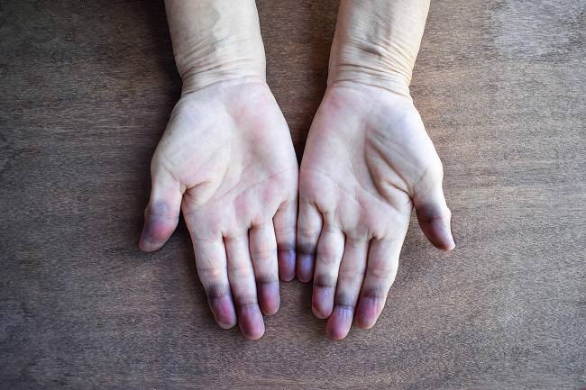 Methemoglobinemia