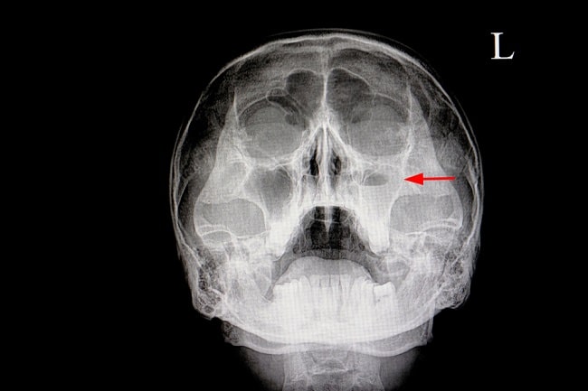 Chronic Sinusitis Symptoms And Causes Mayo Clinic Chronic Sinusitis Symptoms And Causes Mayo Clinic