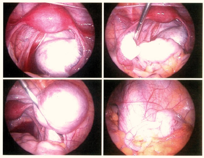 Diagnosis Endometriosis Alomedika