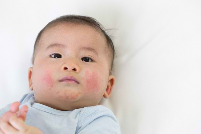 Lindungi Balita dari Penularan Roseola Infantum - Alodokter