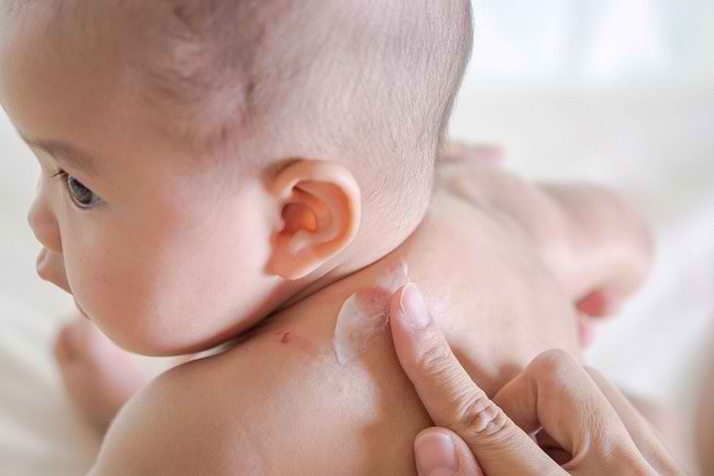 Bintik Merah pada Kulit Bayi yang Umum Terjadi - Alodokter