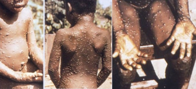 Epidemiologi Cacar Monyet - Alomedika