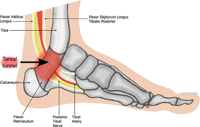  Tarsal  Tunnel Syndrome patofisiologi diagnosis 