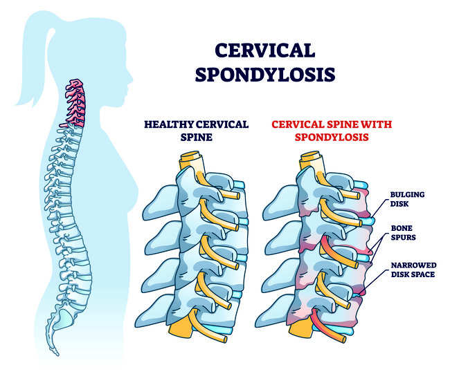 spondilosis servikal - alodokter