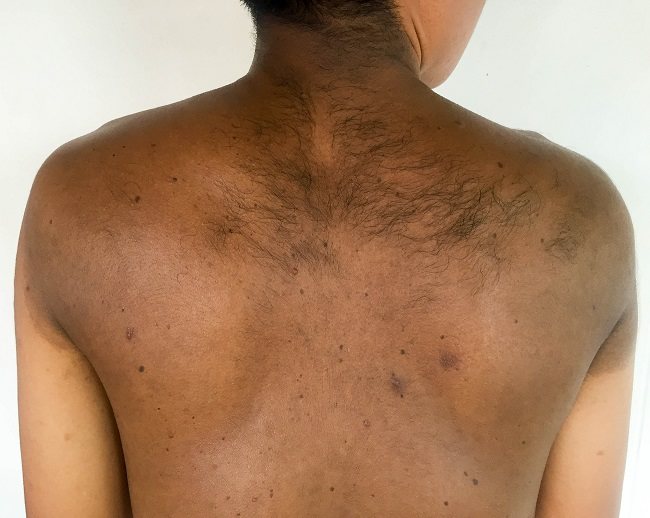alodokter-neurofibromatosis-tipe1