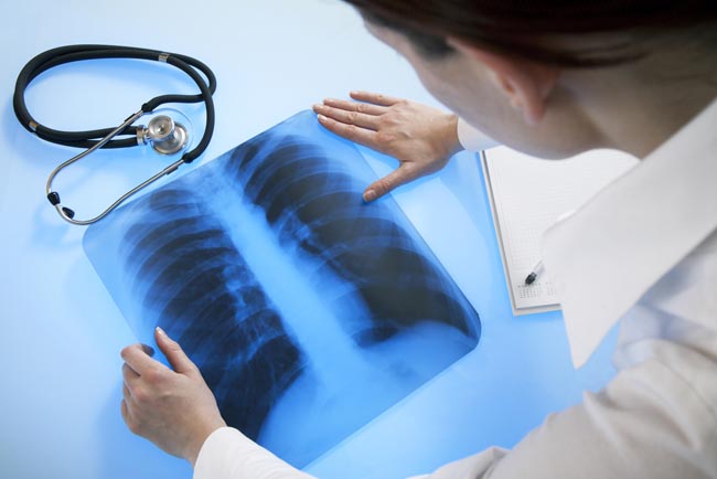 Penyebab pembengkakan paru-paru pada orang yang terkena penyakit emfisema adalah