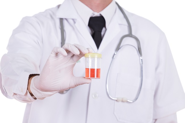 Hematuria-Alodokter