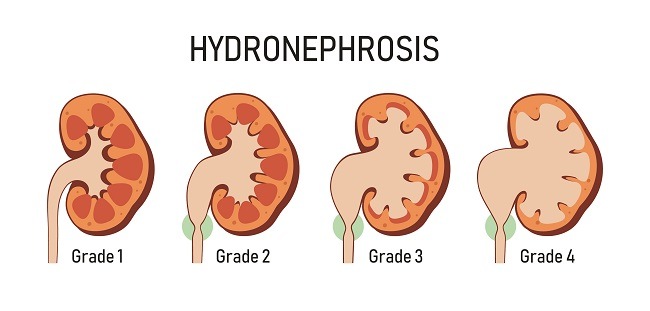 Hidronefrosis-alodokter
