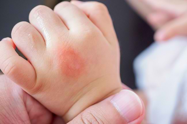 Memilih Obat Anti Nyamuk yang Aman untuk Bayi - Alodokter