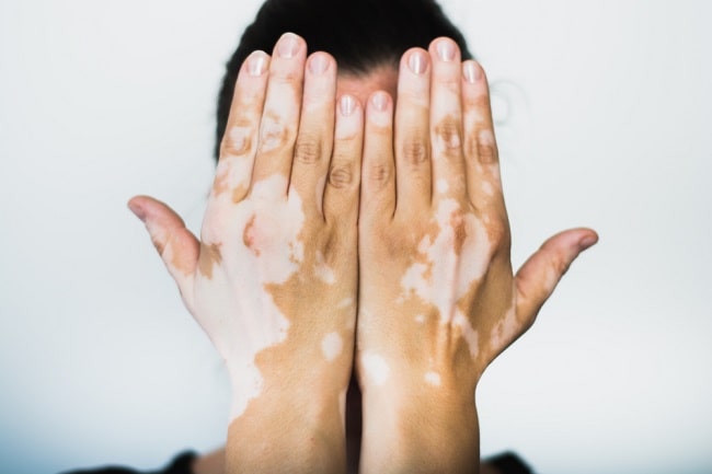  Vitiligo  patofisiologi diagnosis penatalaksanaan 