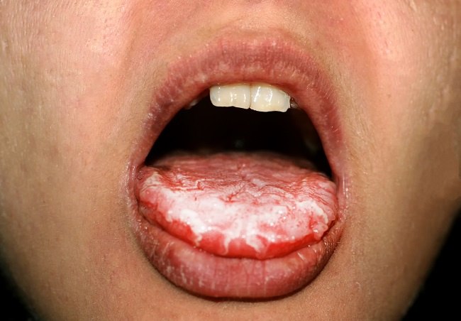 alodokter-candidiasis