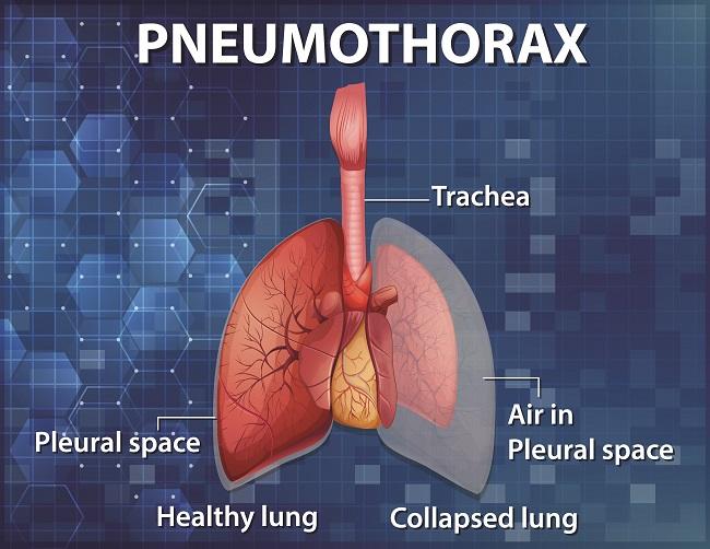 Pneumothorax-alodokter