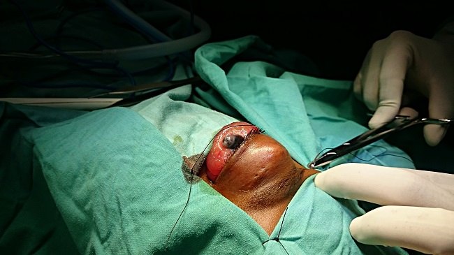 Rhabdomyosarcoma - alodokter