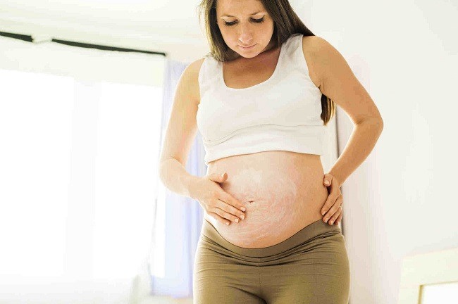Wanita dan Fenomena Stretch Mark - Alodokter