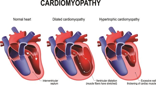 Cardiomyopathy - alodokter