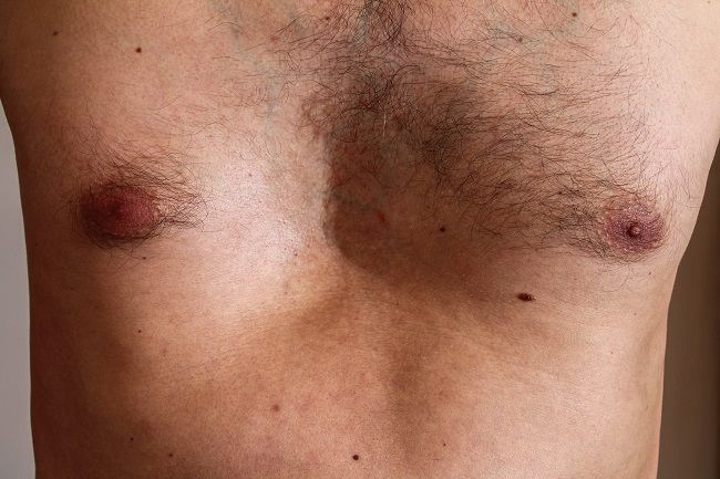 Pectus Excavatum - alodokter