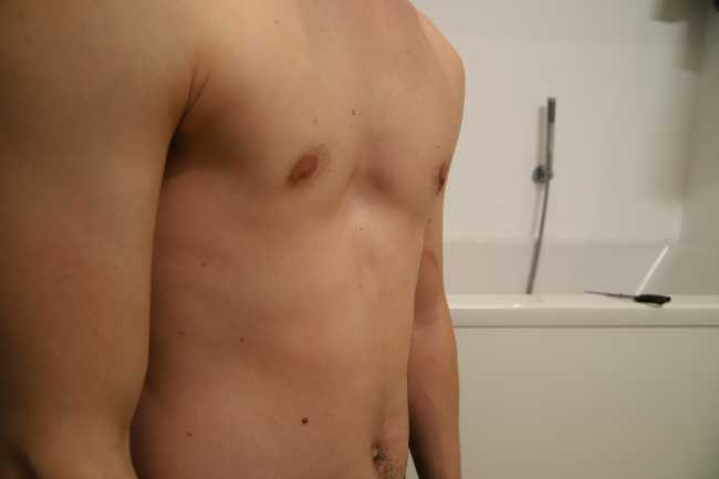 Pectus Excavatum