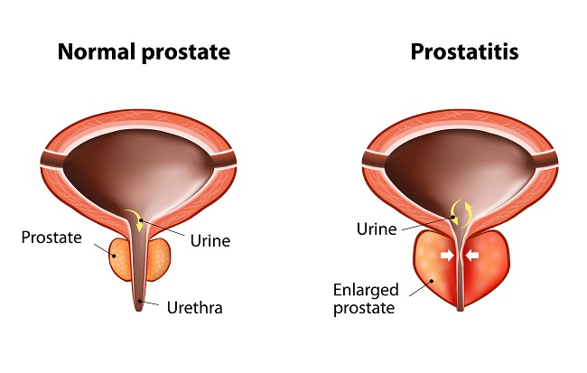krónikus prosztatitis tippjei prostate adenoma radiopaedia