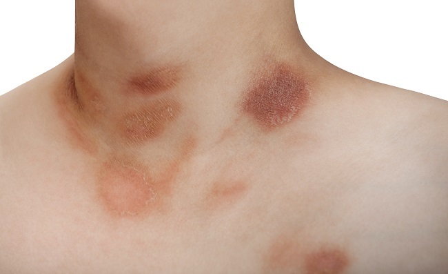 Pityriasis Rosea Gejala Penyebab Dan Mengobati Alodokter