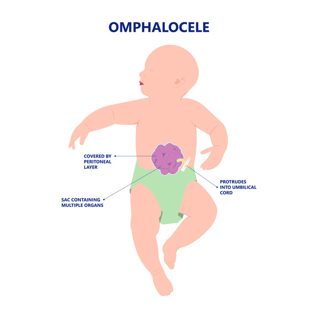 Omphalocele