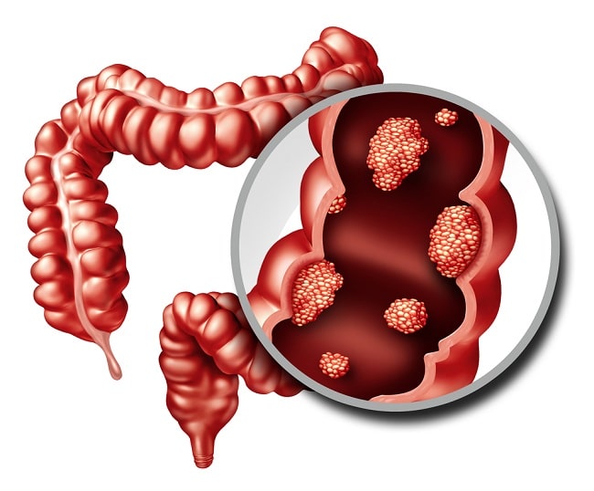cancer colorectal markeri tumorali