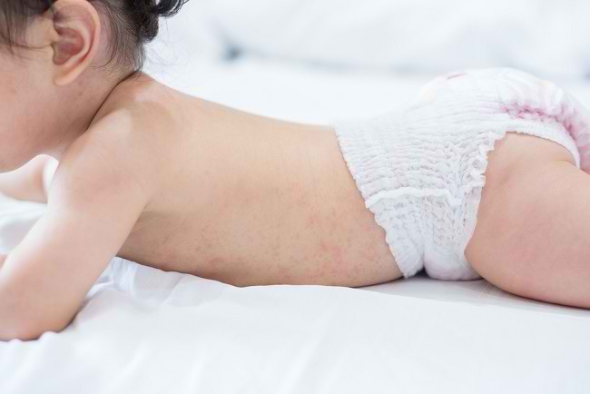 Mengatasi Biang Keringat pada Bayi agar Tidak Menjadi Kondisi Serius - Alodokter