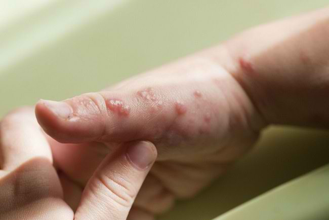 Penanganan Herpes pada Bayi Sebaiknya Jangan Ditunda - Alodokter