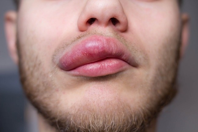 Swollen lip