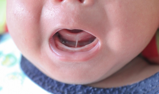 Ankyloglossia - alodokter