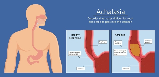 Achalasia - alodokter