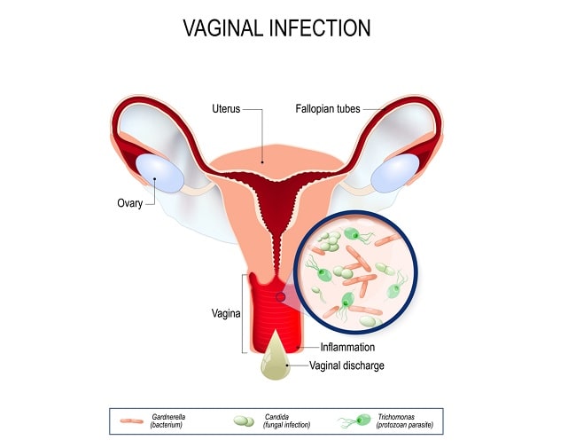 Vaginitis Patofisiologi Diagnosis Penatalaksanaan Alomedika 