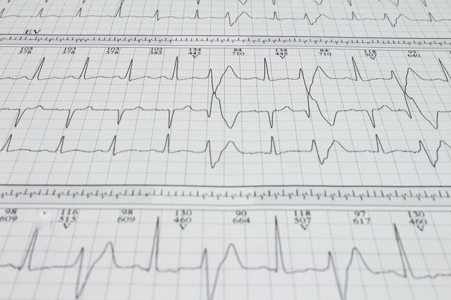 Patofisiologi Ventricular Tachycardia Alomedika Porn Sex Picture