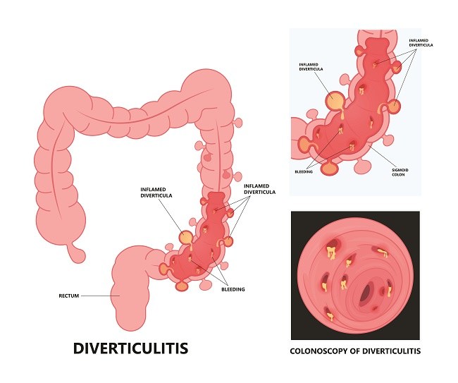 Diverticulitis - alodokter