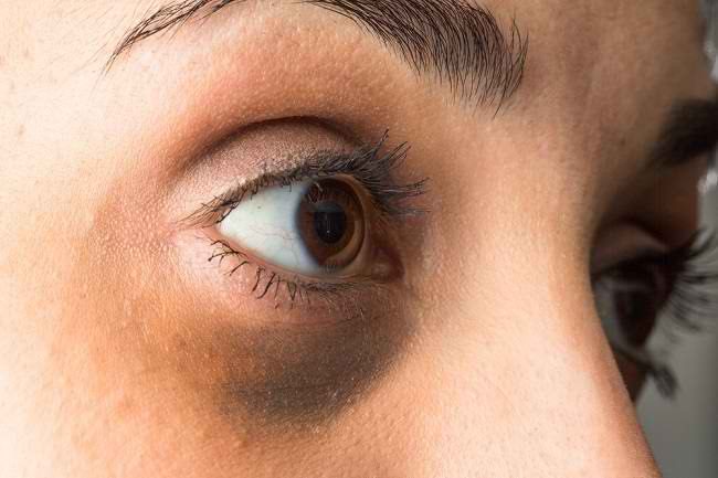 Mata Panda Tidak Hanya Disebabkan oleh Kurang Tidur - Alodokter