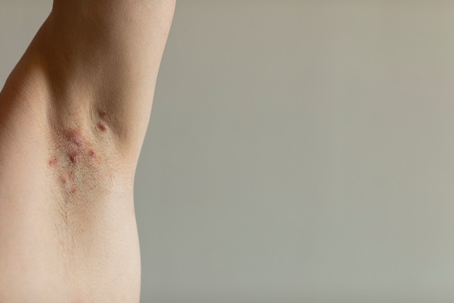Hidradenitis Suppurativa - alodokter