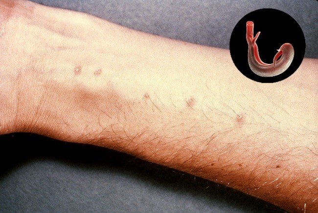 Sumber Gambar: Centers for Disease Control and Prevention's Public Health Image Library, Wikimedia Commons, 1986.