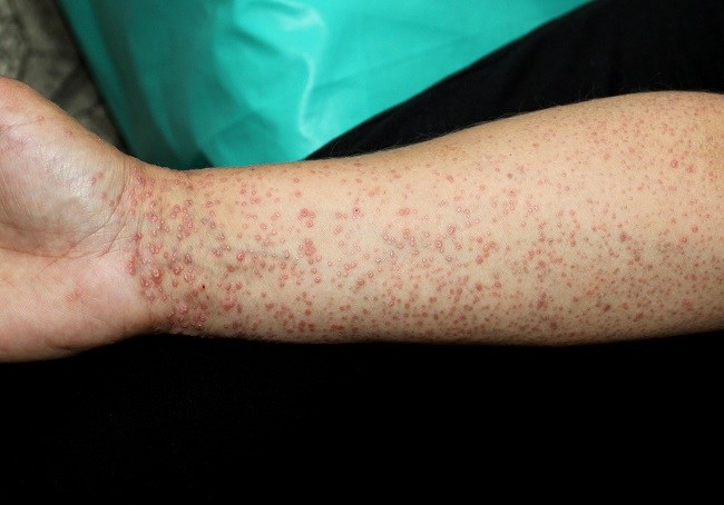 Lichen Planus - alodokter
