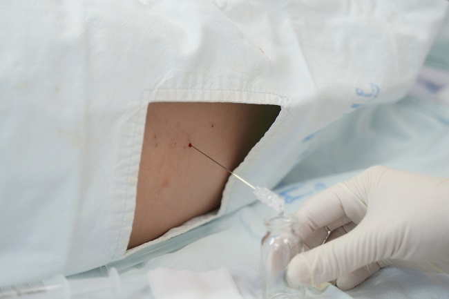 Informasi Seputar Lumbal Pungsi (LP) yang Harus Anda Ketahui - Alodokter
