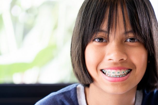 5 Fakta tentang Penggunaan Kawat Gigi pada Anak - Alodokter