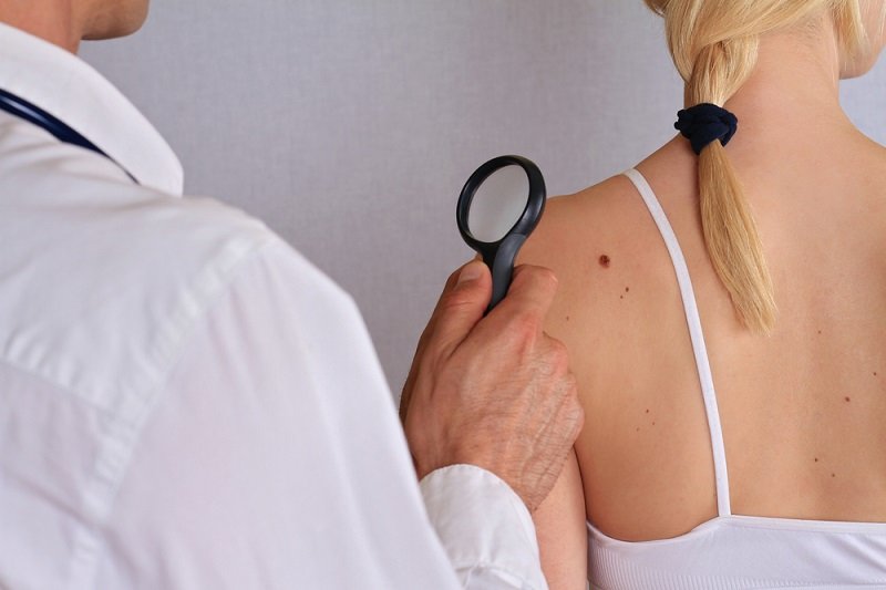 Penyebab dan Cara Menghilangkan Skin Tag dengan Aman - Alodokter