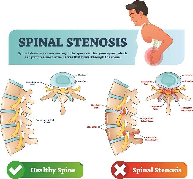 Spinal stenosis - alodokter