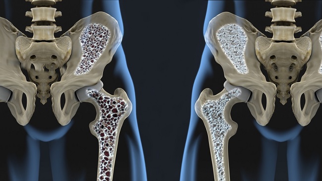 Jelaskan faktor penyebab terjadinya osteoporosis